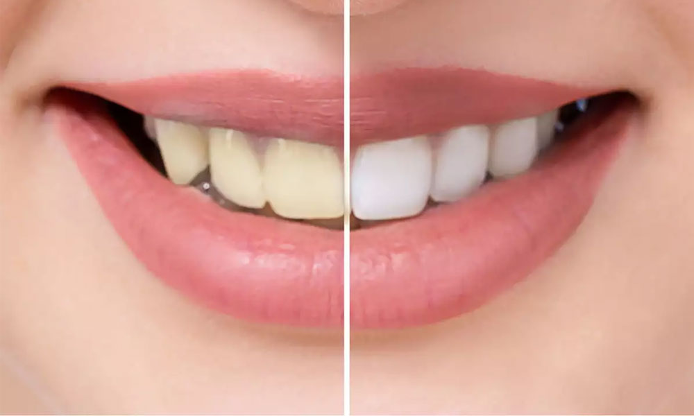 چگونه دندانهای خود را به طور طبیعی در خانه سفید  کنیم ؟